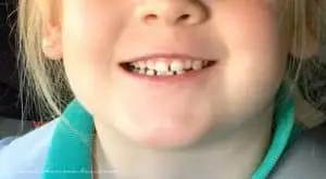 dientes de leche