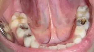 caries en dientes de leche