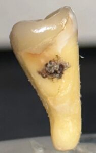 Vista distal de segundo molar permanente izquierdo con acumulo de placa dentobacteriana