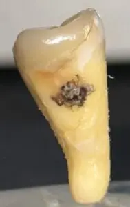 Vista distal de segundo molar permanente izquierdo con acumulo de placa dentobacteriana
