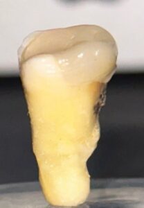Vista lingual de segundo molar permanente izquierdo con rebsorcion a nivel apical